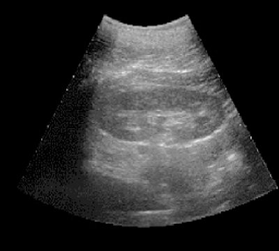 Pharmacoultrasonogram of the kidney with furosemide with undisturbed urine passage - initial data (a)