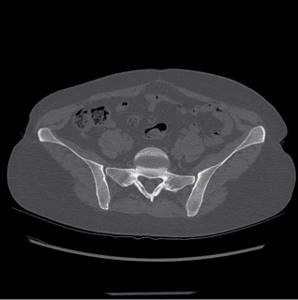 Fibrous dysplasia of the pelvic bones on CT
