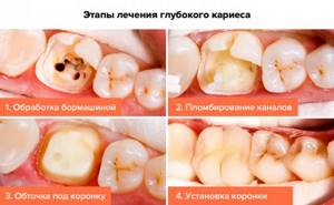 Photos of the stages of treatment of deep caries