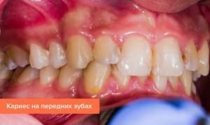 Photo of caries on the front teeth