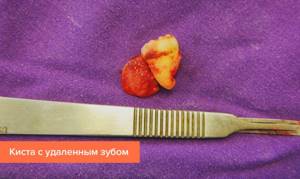 Photo of a cyst with an extracted tooth