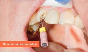 Photos of front teeth treatment