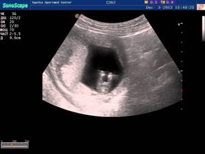 Photo of ultrasound of the first screening at 13 weeks of pregnancy