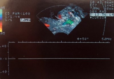 Fragment of a video recording of Doppler ultrasound assessment of urine flow in the prostatic urethra using a rectal sensor