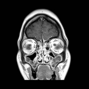 sinusitis on MRI image