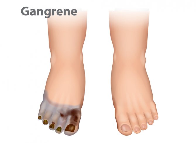 Gangrene, caused by Clostridia