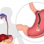 Gastroscopy: indications, preparation and procedure