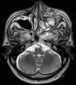 Maxillary sinus hemangioma on MRI