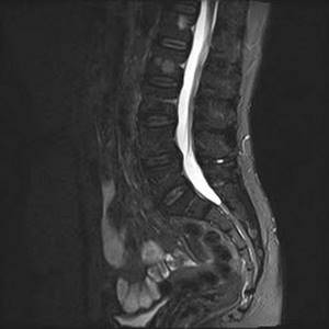 Hemangiomas on an MRI image