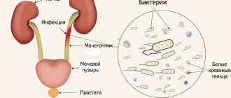 Hematuria infection diagram