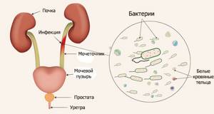 Hematuria infection diagram