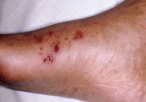 Hemorrhagic rash
