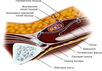 hernioplasty