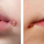Herpes in children: vesicular rashes and aphthae