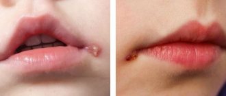 Herpes in children: vesicular rashes and aphthae