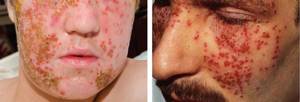 Kaposi&#39;s eczema herpetiformis