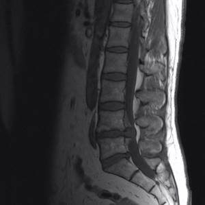 Giant lumbar disc herniation on MRI