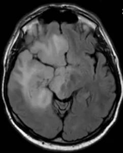 Glioblastoma on MRI of the brain