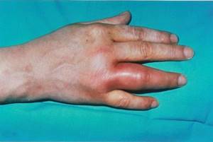 Gonococcal arthritis