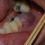 Tooth root granuloma - what is it and how to treat it
