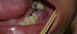 Tooth root granuloma - what is it and how to treat it