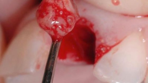 Tooth granuloma, what is this disease and how to cure it