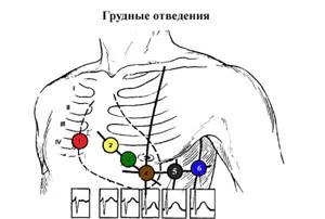 Chest leads
