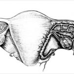 Хронический сальпингит, крестообразное рассечение ампулы маточной трубы при сальпингостомии
