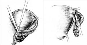 Хронический сальпингит, крестообразное рассечение ампулы маточной трубы при сальпингостомии
