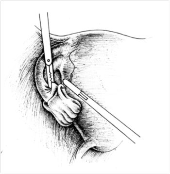 Chronic salpingitis, inversion of the petals of the fallopian tubes during salpingostomy