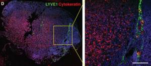 Immunofluorescence imaging of a metastatic lymph node with cytokeratin staining