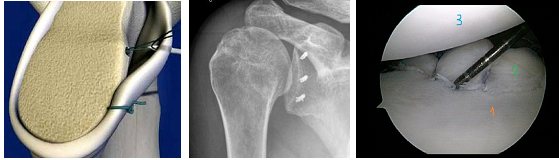 Impression fracture of the humeral head