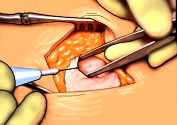 excision of inguinal hernia