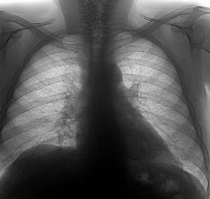 Changes in the lungs are visible on a fluorographic image