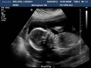 Fetal image obtained during 2nd trimester examination
