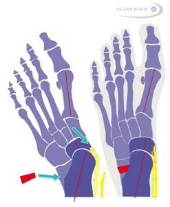 Image of longitudinal-transverse flatfoot with a weakened tendon of the tibialis posterior muscle.