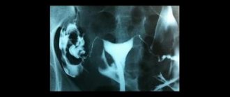 How to do an x-ray of the fallopian tubes
