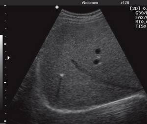 Calcification in the liver parenchyma with a typical acoustic shadow phenomenon