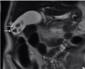 Stones on MRI of the gallbladder