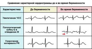 cardiogram before and during pregnancy