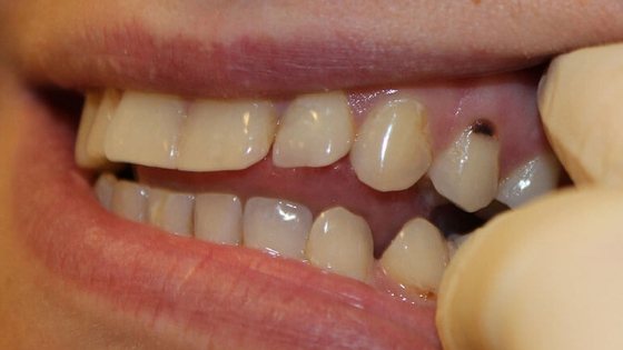 Tooth root caries treated or removed