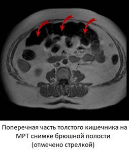 Intestine in MRI image