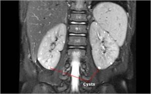 Kidney cyst on MRI
