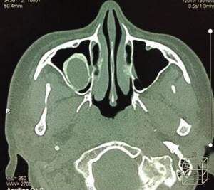 Cyst in the sinus