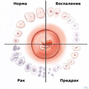 Клетки эпителия при нормальном состоянии шейки матки и патологических изменениях