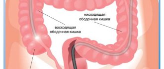 intestinal colonoscopy