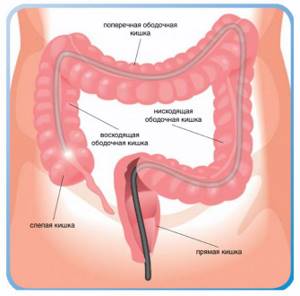 intestinal colonoscopy