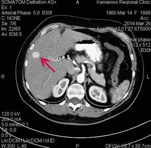 Computed tomogram of FNH of the liver in patient R: arterial phase