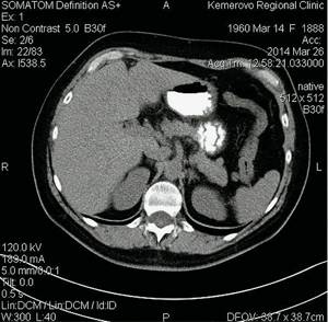 Computed tomogram of FNH of the liver in patient R: native phase