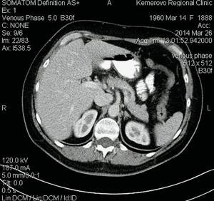 Computed tomogram of FNH of the liver in patient R: excretory phase